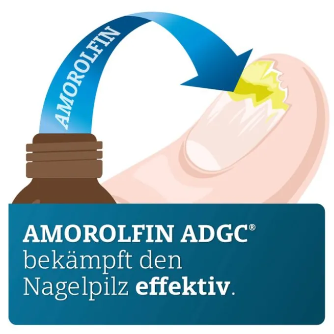 AMOROLFIN ADGC 50 mg/ml wirkstoffhalt.Nagellack 5 ml