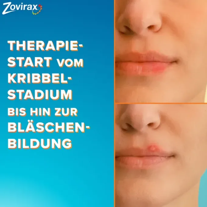 ZOVIRAX Lippenherpes Creme 2 g
